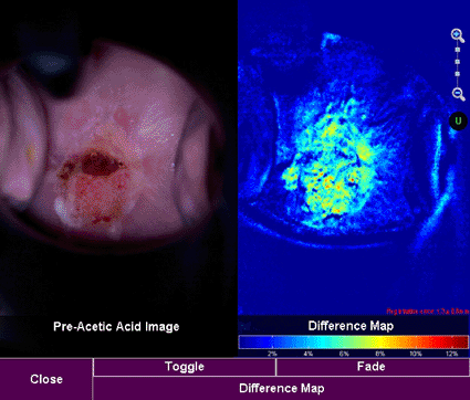 Image: A difference map demonstrating acetowhitening on the UltraSight HD Digital Colposcopy System (photo courtesy STI Medical Systems).